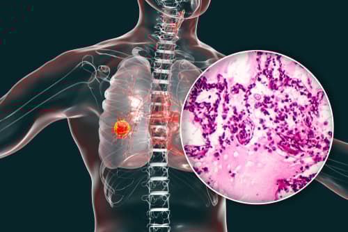Identifying Signature Biomarkers of Lung Adenocarcinoma Using Integrative Epigenomics, Transcriptomics Analysis