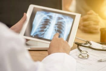 Lung Cancer Screening Program Shifts the Stage of Lung Cancer at Diagnosis in Veterans